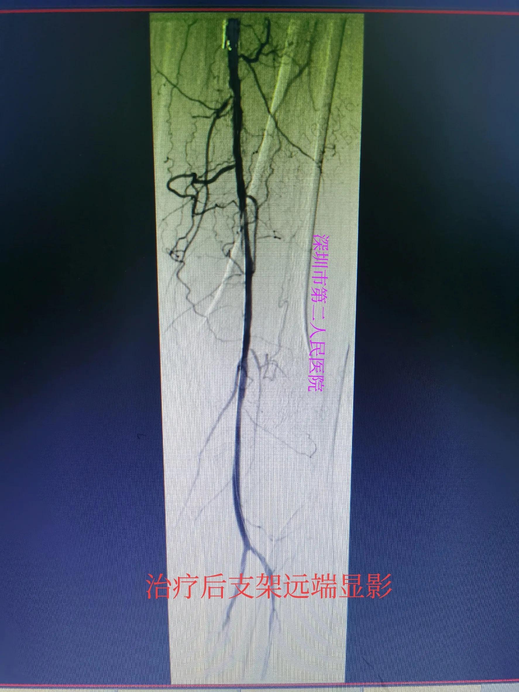 老年人小腿浮肿发紫什么原因,老人突然小腿发凉发软