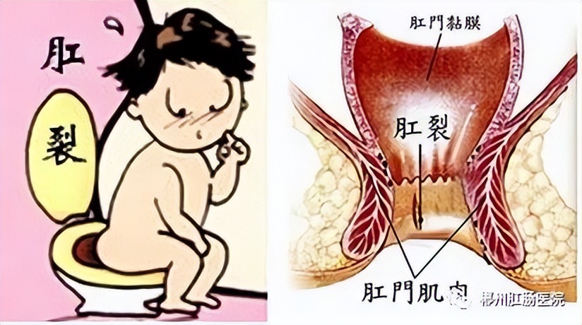 便后肛门疼痛难忍怎么治疗,便后肛门疼怎么治疗