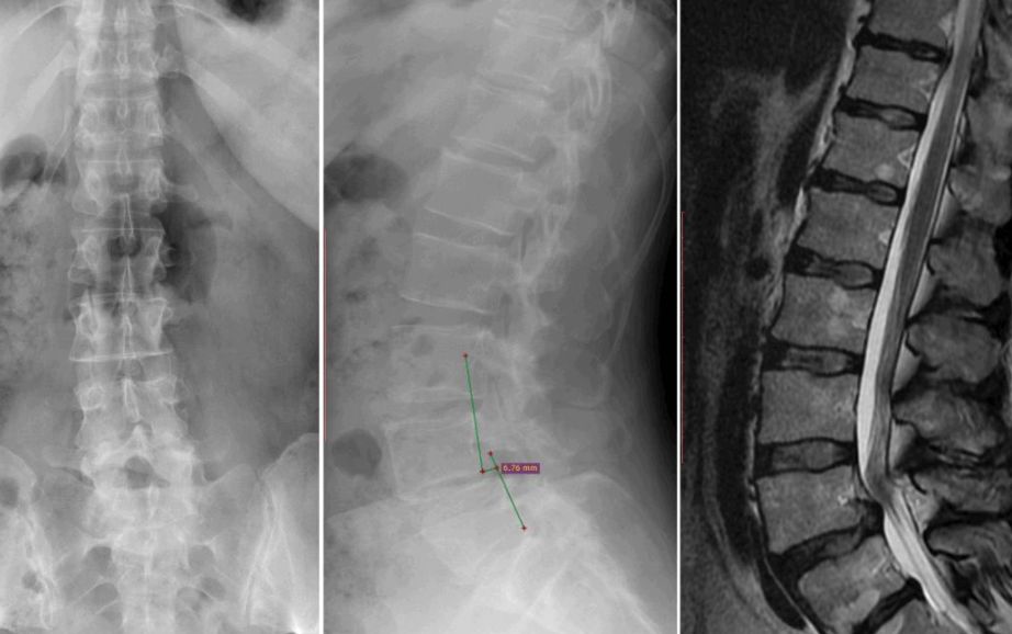 腰椎滑脱手术治疗风险大吗,腰5骶1腰椎滑脱怎么治疗