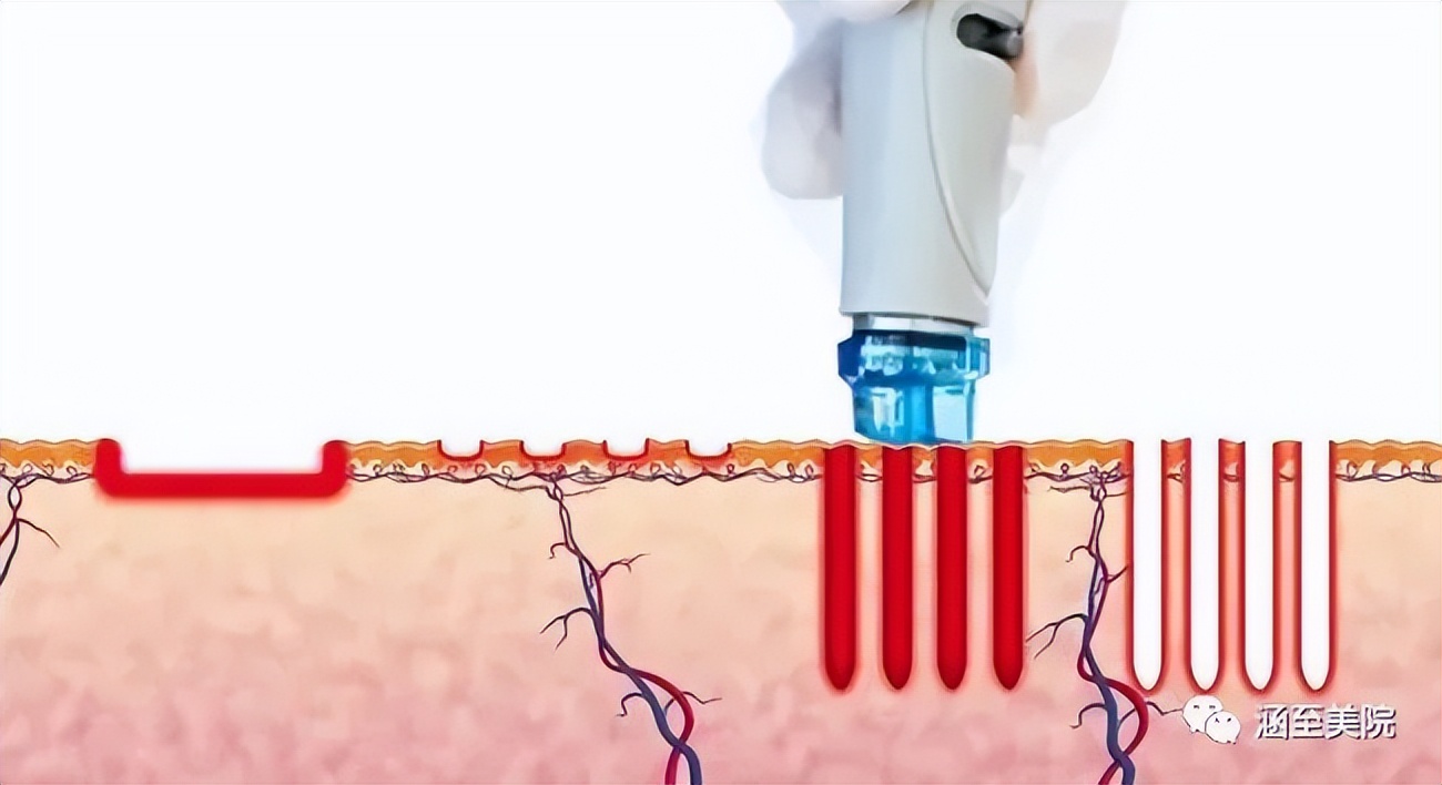 热玛吉处理脖子松弛效果怎么样,颈部皱纹很深热玛吉能去除吗