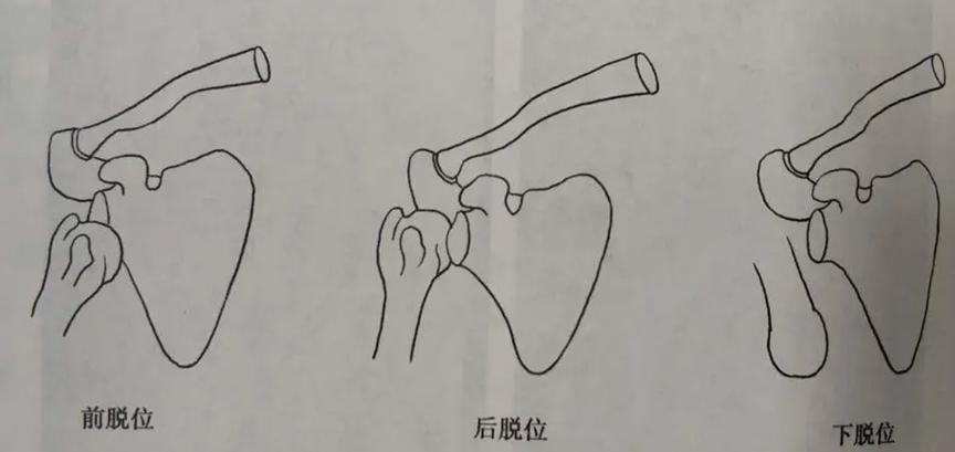 如何避免肩关节脱位，肩关节脱位是怎么造成的？
