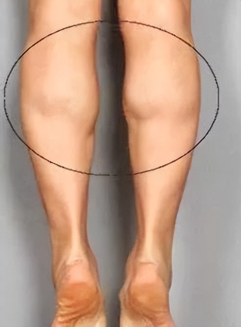 女生小腿肌肉怎么瘦医美,女孩小腿肌肉发达如何变细腿