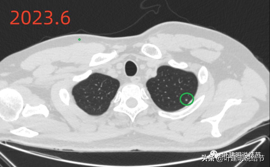 肺炎好了磨玻璃结节还存在,球形肺炎治愈后肺部留有结节