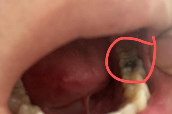 牙齿蛀虫怎么消灭最快最好方法,牙齿烂透不处理会怎样