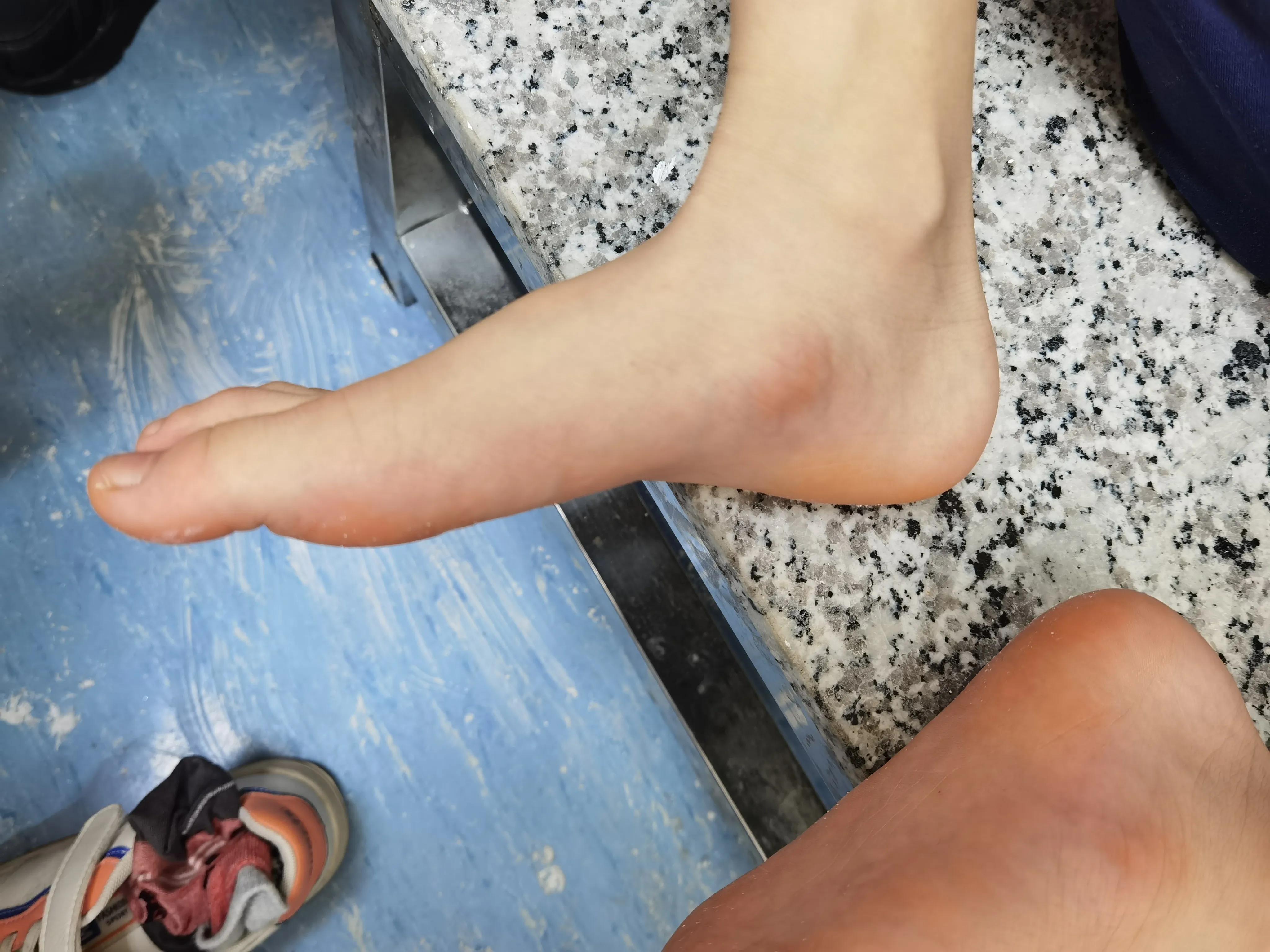 如何判断孩子足部有问题,儿童青少年的足部问题