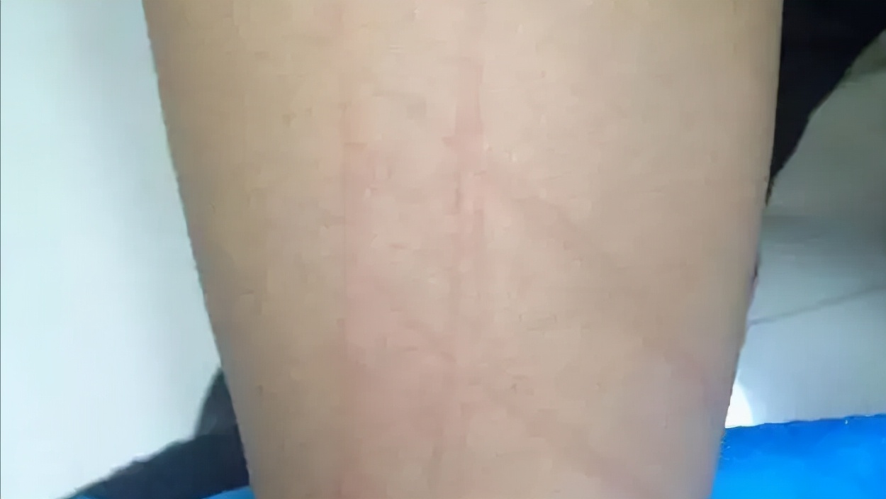 荨麻疹老是反复发作痒怎么治,荨麻疹有灼热刺痒怎么快速解决