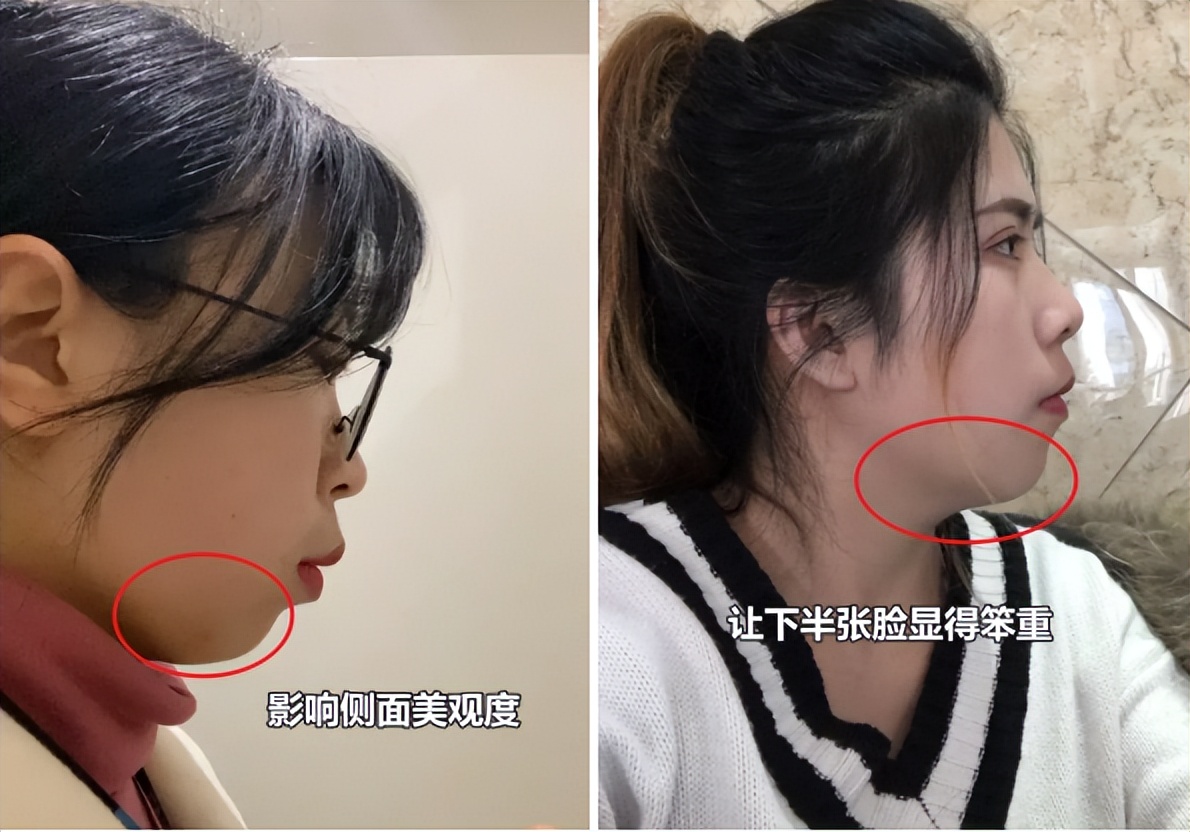 为什么大部分亚洲人都是扁头,正脸好看但侧脸丑到爆怎样办