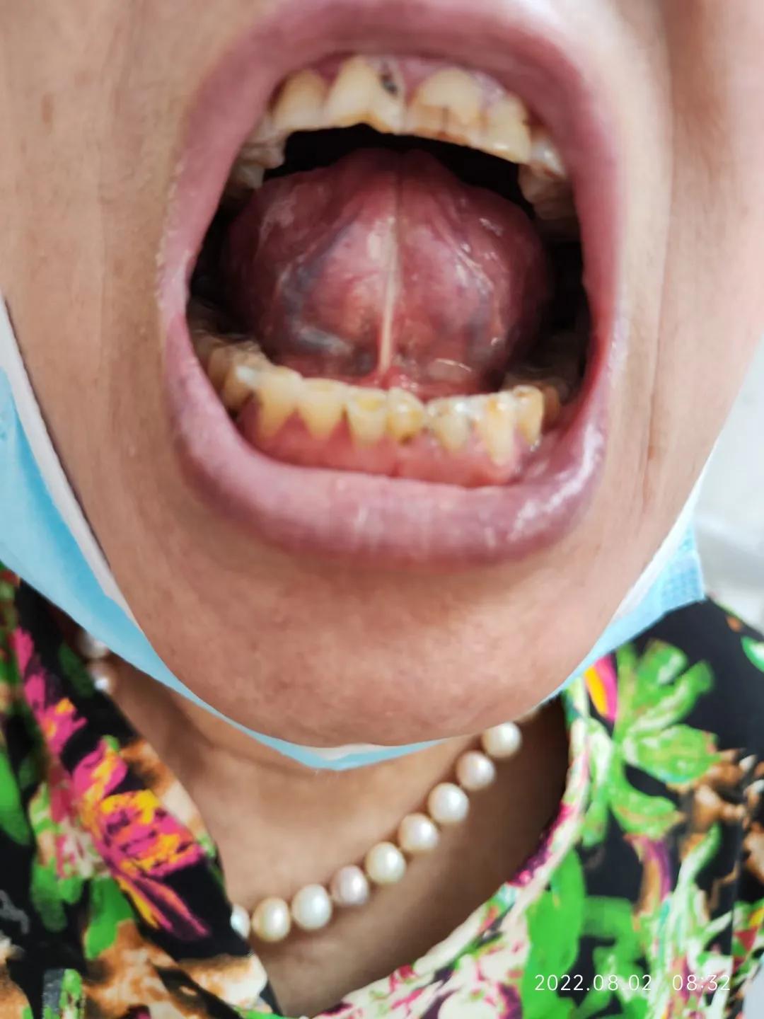 口服中药3个月，确诊5年的干燥综合征患者病情明显缓解