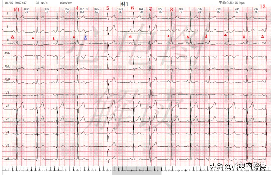 室性并行心律可能有间位性的吗,加速的室性逸搏心律的心电图表现