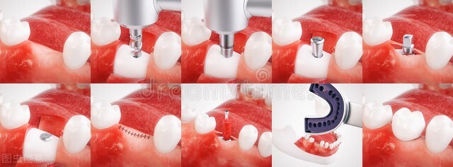 镶牙跟种植牙哪个比较好,种植牙真的比镶牙更好吗