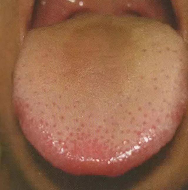 大便粘稀不畅吃什么中成药,大便粘不成形吃什么药最有效