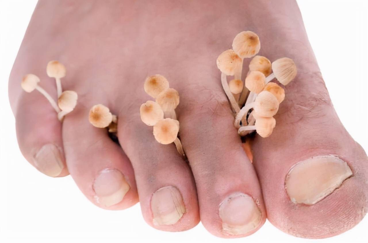 脚气反复治不好中医泡脚有妙招,脚气治不好了怎么办