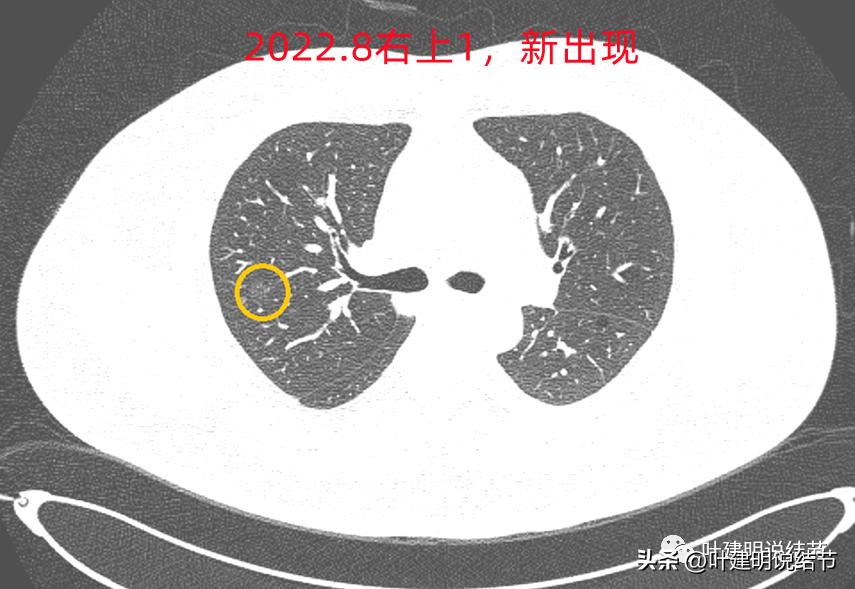 如何判断肺磨玻璃结节是高危结节,肺上有混合磨玻璃结节要注意什么