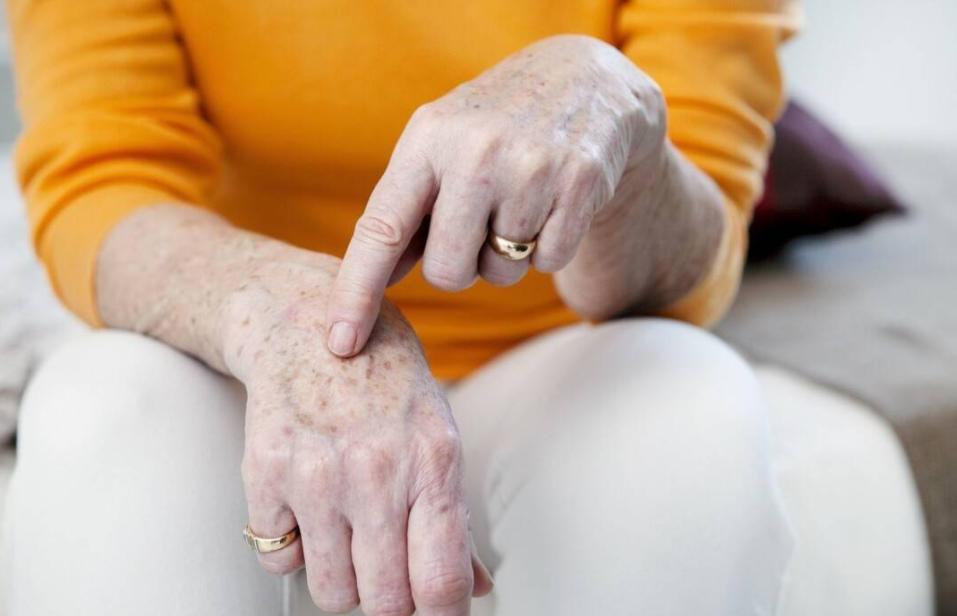 祛老年斑涂抹什么药膏有效,快速消除老年斑的小妙招红霉素