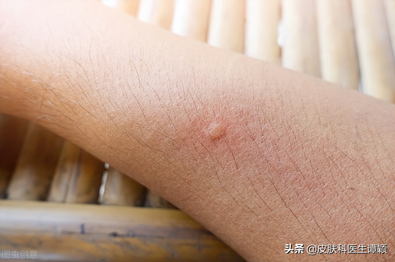 丘疹性荨麻疹皮炎有哪些忌口,丘疹性荨麻疹止痒小妙招是什么