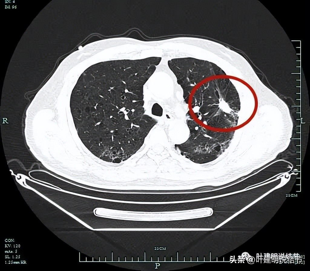 pet判断淋巴结转移,petct判断癌有没有转移准确吗