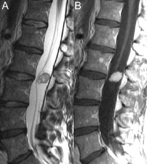 原发性肝癌的磁共振影像诊断,原发性腰椎肿瘤有哪些