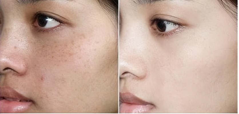 淡斑效果排名第一哪款口碑最好,维生素e哪个牌子好纯天然淡斑