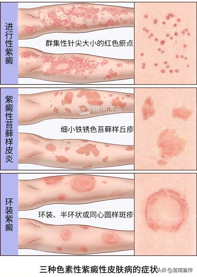 身上长这几个小红点是癌症,身上长了红点看什么科