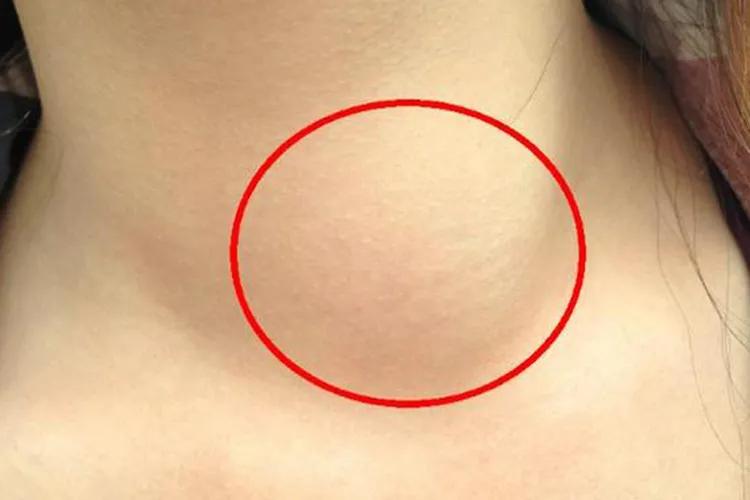 甲亢病是什么症状图片大全,甲亢病眼睛有什么症状