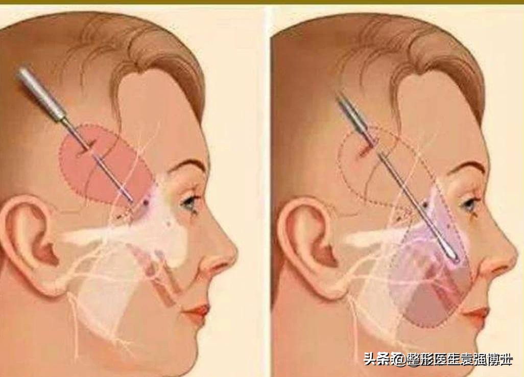 小拉皮20天恢复效果图,拉皮手术后75天复查