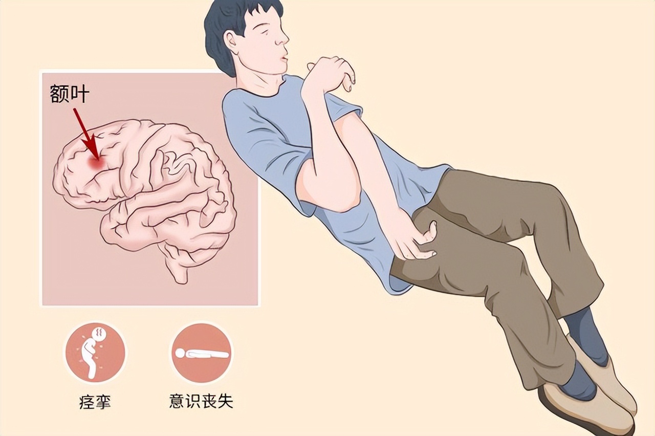 癫痫治疗传统方子,治疗癫痫的经典验方