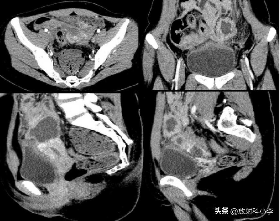 妇科急腹症的ct表现,妇科急腹症的诊断与治疗