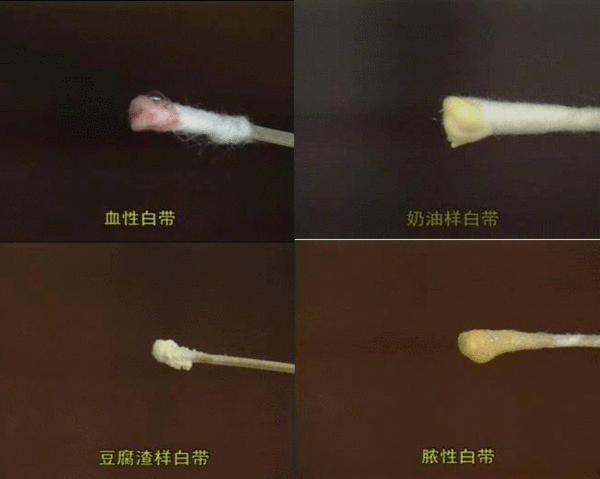 白带是鱼腥味的是怎么回事,白带有鱼腥味是什么原因