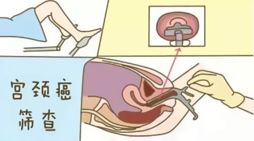 做妇科阴式超声最好啥时候做,妇科超声和腔内超声是一个检查吗