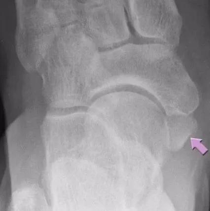 如何判断孩子足部有问题,儿童青少年的足部问题