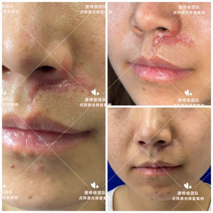 疤痕早期激光干预,疤痕激光治疗最佳方法