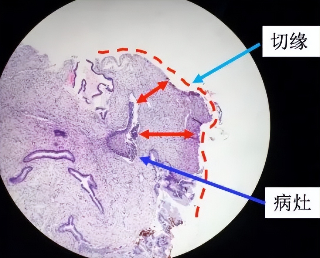 胃癌中晚期恶性肿瘤怎么治疗好,恶性程度低的胃癌