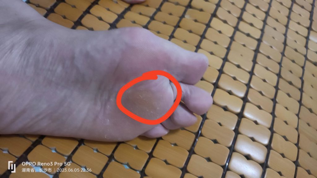 拇外翻疼痛是什么原因,如何治疗拇外翻疼痛的方法图解