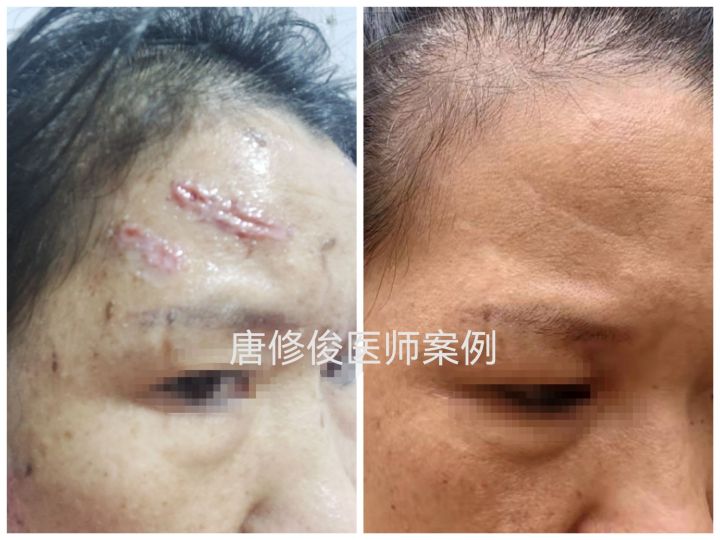 点阵激光后的伤口要几天愈合,伤口做点阵激光治疗