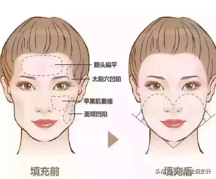 额头不饱满用什么填充最好,颞骨凹陷适合填充什么