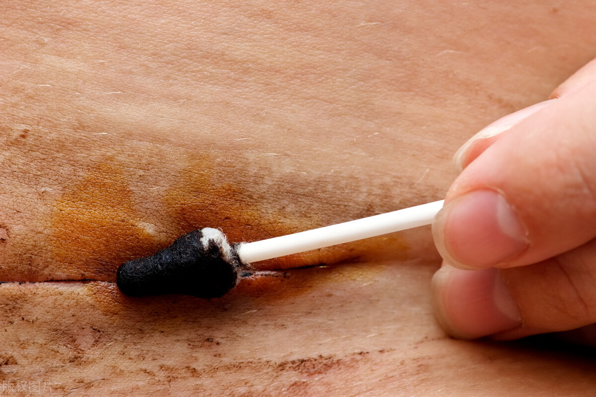 宝妈祛剖腹产疤真实案例,刨腹产妇产后疤痕去除推荐