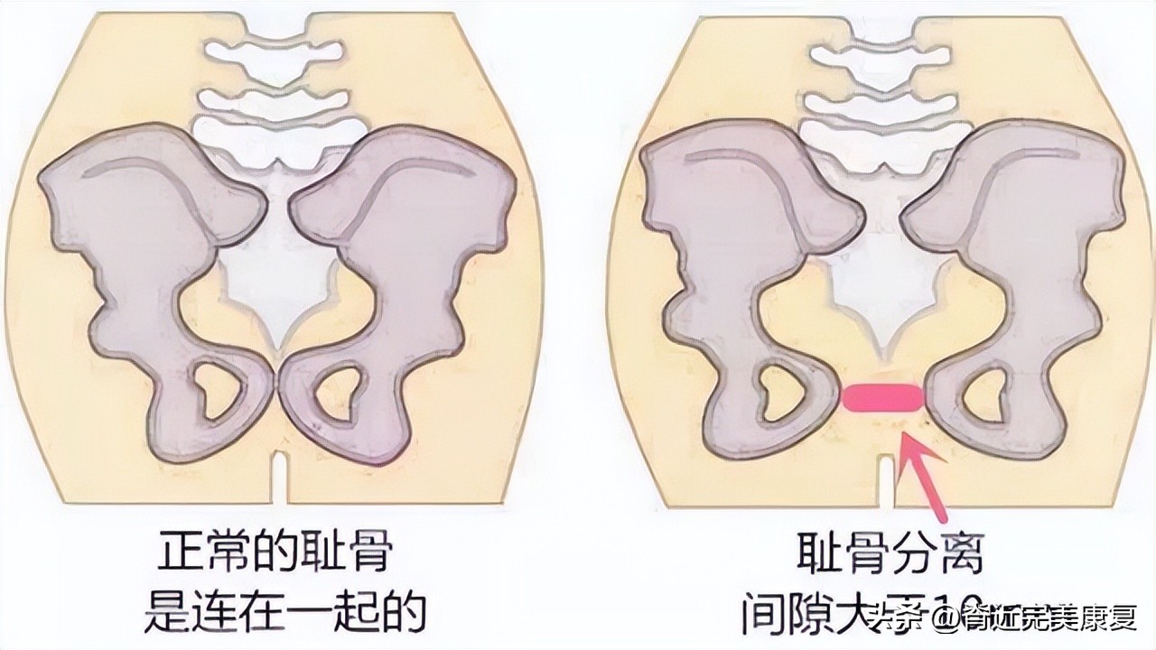 生完孩子后腹直肌一定会分离吗,生完孩子后腹直肌分离是怎么回事