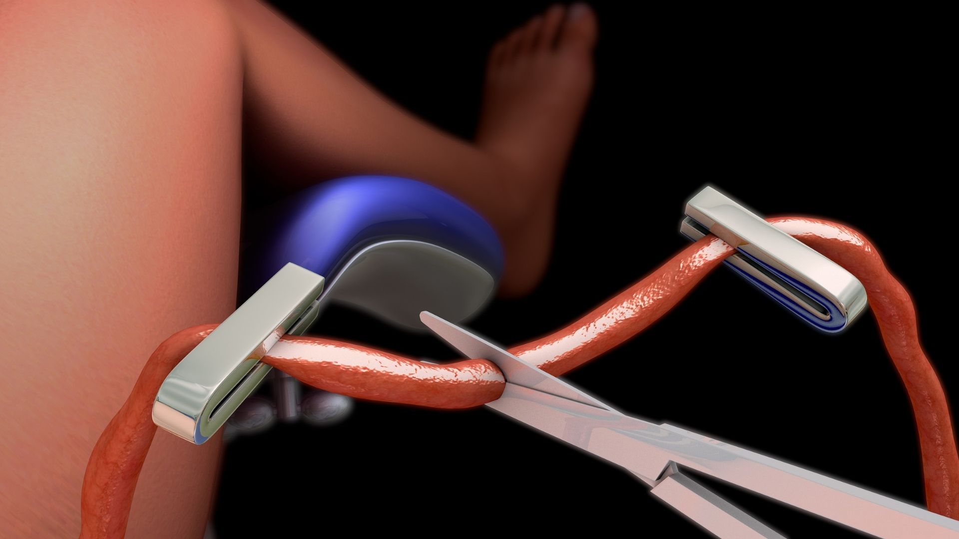 新生儿脐带怎么处理掉得快,新生儿脐带脱落几天后又突然出血