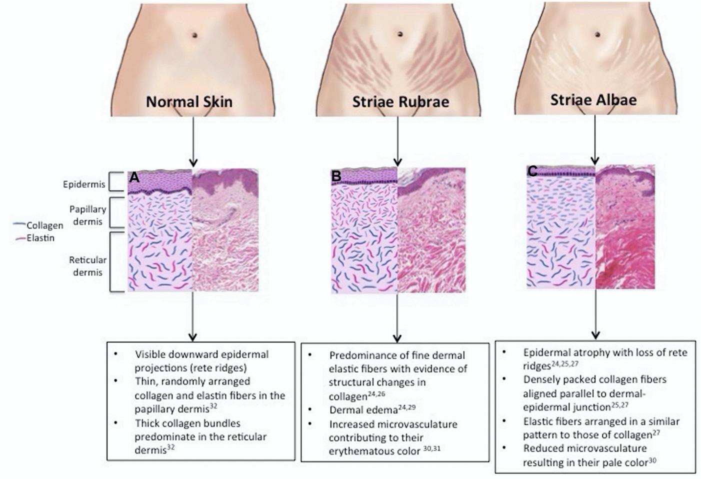 妊娠纹有什么好的产品推荐吗,有效去妊娠纹的产品推荐