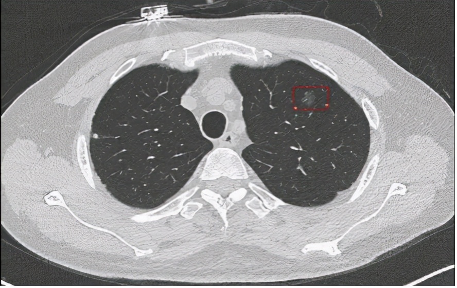 肺癌晚期治疗成功案例用什么方法,肺癌早期患者抗癌之路