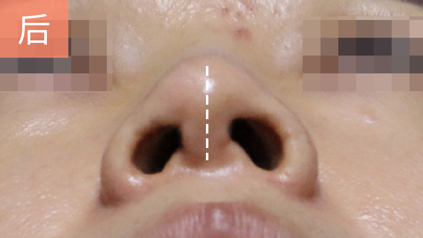 北京八大处整形医院歪鼻矫正,北京同仁医院鼻科知名专家排名