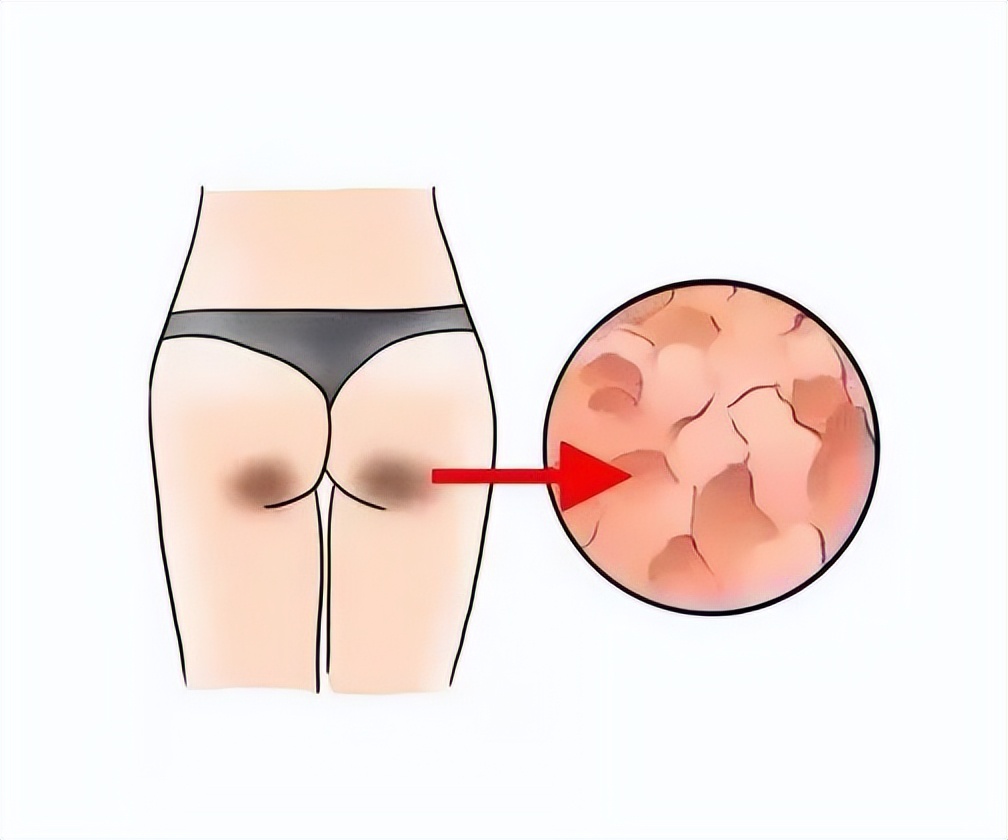 手肘皮肤发黑开裂粗糙,手肘处皮肤发黑去除小妙招