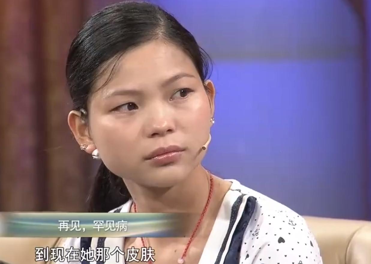 刚出生的小孩皮肤有黑斑,全身长满黑斑的小孩后来怎样了