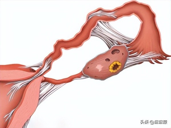 慢性盆腔炎的治疗方法,慢性盆腔疼痛哪治疗好