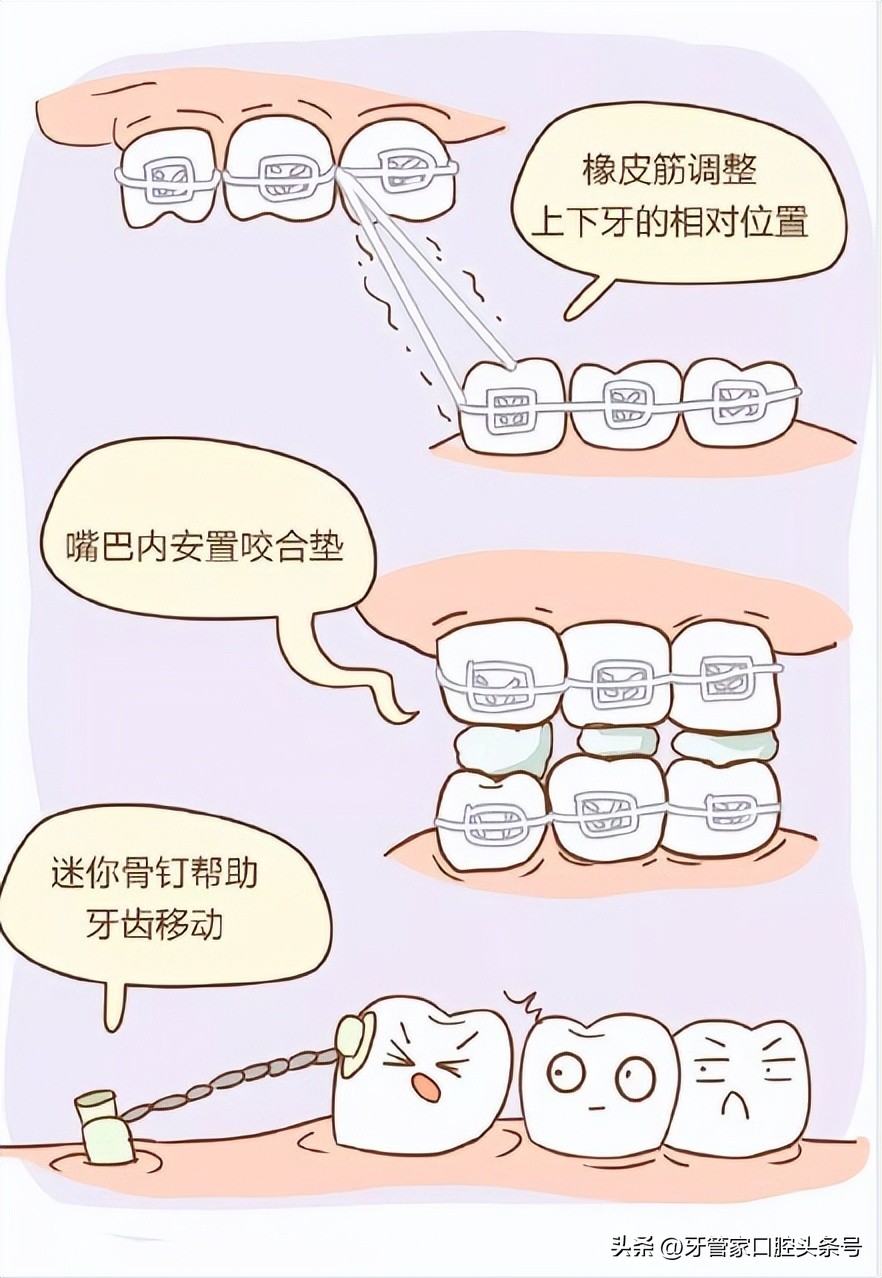 戴隐形矫正牙套注意事项,什么时候戴矫正带是最佳时间