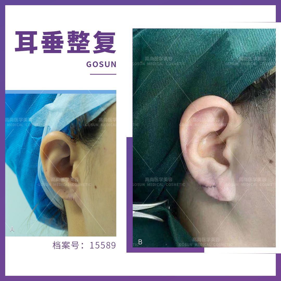 耳垂缺损|耳垂缺了一块还能复原吗？
