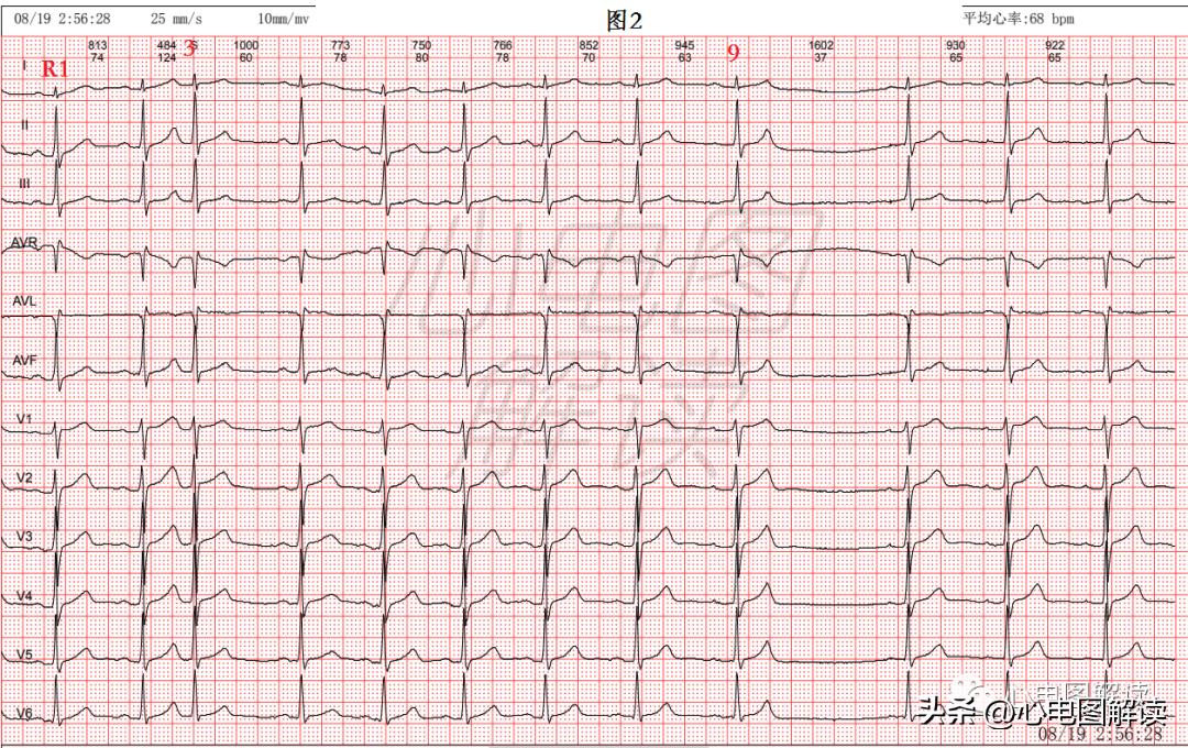 房早室早区别,房早室早房颤