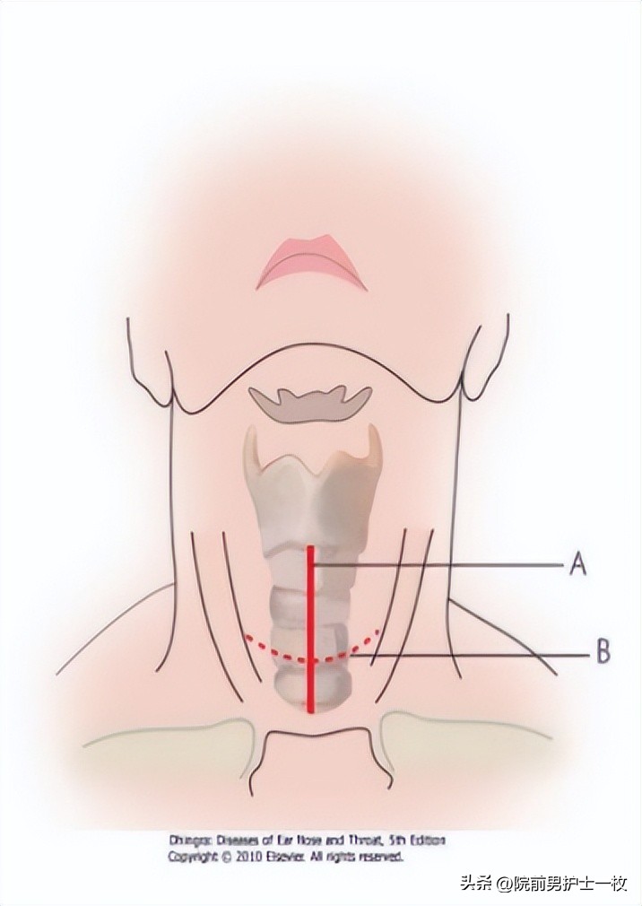 关于气管切开技术流程及注意事项