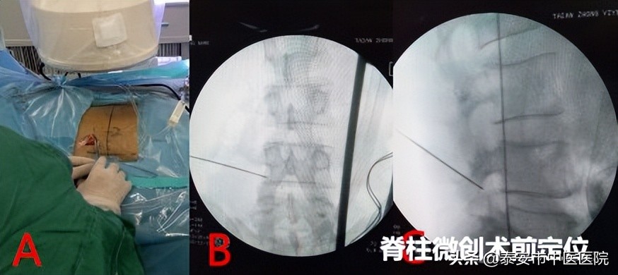 【中医特色，治骨疗伤】铁骨铮铮“脊”往开来——记*安泰**市中医医院（*安泰**市骨伤医院）脊柱外科