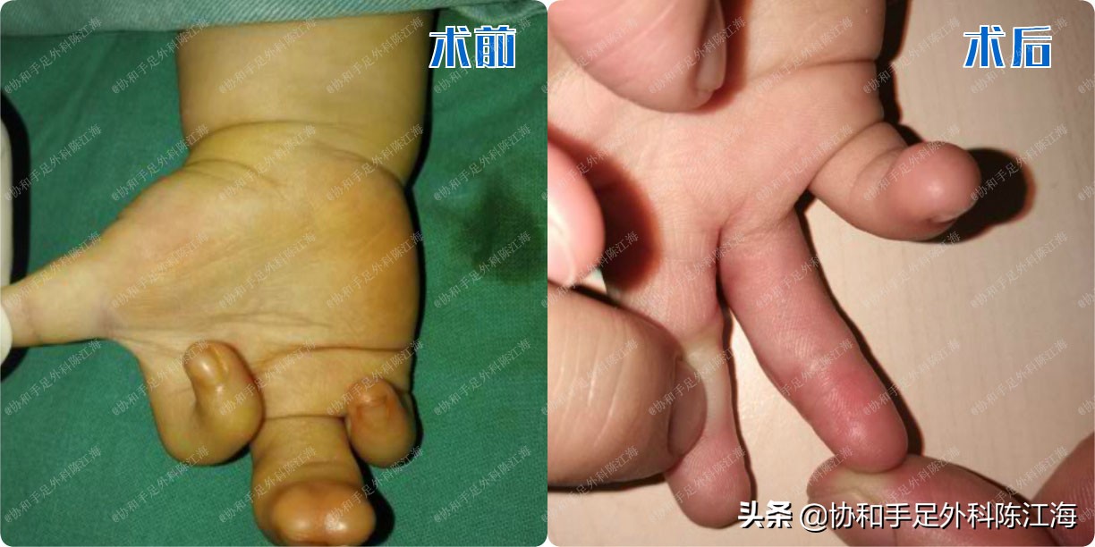 孩子四肢粘连,手脚粘连的婴儿